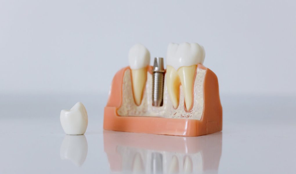 biološki inženirski implantati