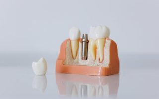 biološki inženirski implantati